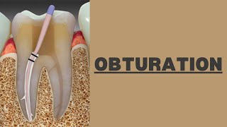 Dental Obturation Technique in Root Canal Treatment [upl. by Trebornhoj10]