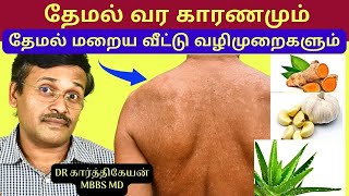 தேமல் மறைய என்ன செய்வது  White patches on face skin home remedies  treatment for tinea [upl. by Nwahsyar]