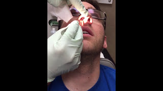 Deviated Septum Splint Removal [upl. by Tressia]