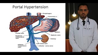 Management of Portal Hypertension and Variceal bleeding [upl. by Nel381]