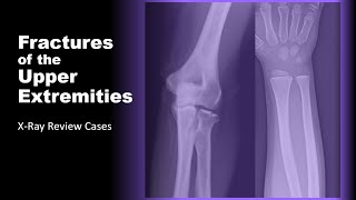 Fractures of the Upper Extremities on XRay radiology xray doctor [upl. by Onofredo884]