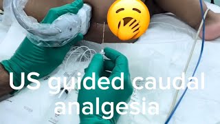 US guided caudal anesthesia [upl. by Jarad842]