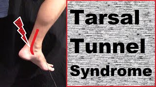 Understanding amp Treating Tarsal Tunnel Syndrome [upl. by Euqinmod]