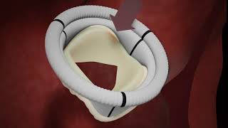 Tissue replacement heart valve [upl. by Rett]