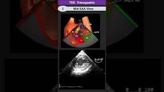 TEE Transgastric Mid SAX View [upl. by Natrav]