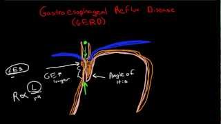 Pathophysiology of Gastroesophageal Reflux Disease GERD [upl. by Anisah]