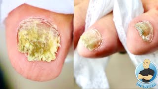 REMOVING 3 FUNGAL TOENAILS AFTER 7 YEARS OF TREATMENT [upl. by Dimo]