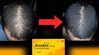 Dutasteride Saves Your Hair [upl. by Neelon]