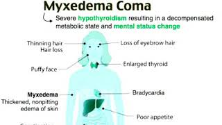 Myxedema comahypothyroidism [upl. by Vowel]