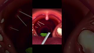 ASMR Removing Fishbone and Tonsil Stones Removal  ASMR Relaxing asmr relax fishbonestitch relax [upl. by Cleodal646]