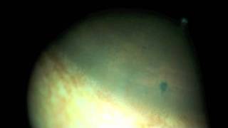 yag laser iridotomy for angle closure glaucoma in a brown iris [upl. by Yellehs51]