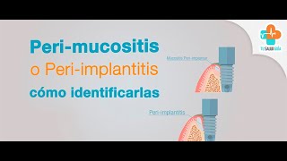 Perimucositis o periimplantitis ¿cómo identificarlas  Tu Salud Guía [upl. by Adym637]