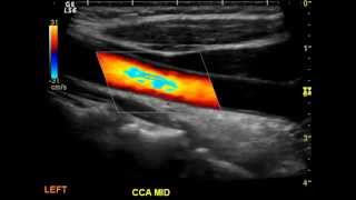 Normal Carotid Duplex [upl. by Franchot]