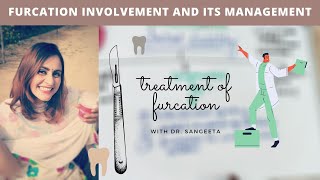 furcation involvement treatment easy explain [upl. by Marelda]