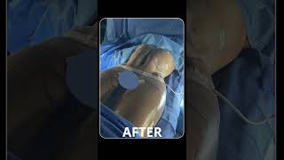 Transforming Apron Belly into an Hourglass Figure After Advanced Tummy Tuck [upl. by Croteau]