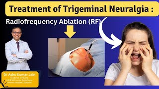 Relief from Trigeminal Neuralgia Effective Treatment with Radiofrequency Ablation [upl. by Orutra]