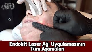 ENDOLİFT LAZER AĞI UYGULAMASININ TÜM AŞAMALARI [upl. by Fitton149]