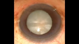 MSICS In An Intumescent Cataract with a NonWell Dilating Pupil and Large Nucleus in 8 Minutes HD [upl. by Russell]