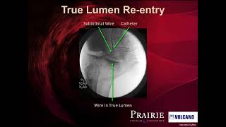 Subintimal Angioplasty and True Lumen Reentry  The Pioneer Plus Catheter [upl. by Neeoma959]