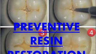 Preventive Resins Restorations I Dental Guide I Dr Bimal Chand I [upl. by Nairrot]