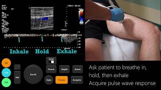 Ultrasound Tutorial DVT  Lower Limb Veins  Radiology Nation [upl. by Ocirrej]