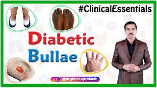 Diabetic bullae Bullosis Diabeticorum  Clinical essentials [upl. by Kristyn]