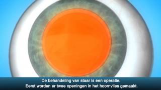 Staaroperatie cataract  OLVG Oogheelkunde [upl. by Asirralc]