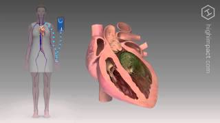 Endocarditis  Proper Antibiotic [upl. by Hedva]