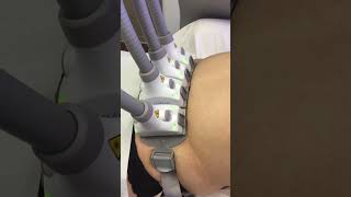 SculpSure Treatment at YPS sculpsure [upl. by Berkly]