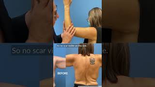 How to place an arm lift scar shorts brachioplasty scarreveal [upl. by Sadoff103]