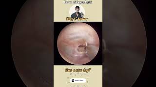 고막염증제거 otitismedia needle aspiration satisfyingvideo ENT [upl. by Aicala719]