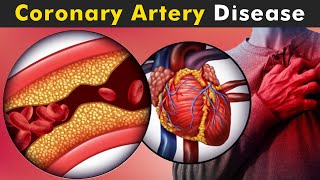 How Coronary Artery Disease Work  Symptoms Causes And Treatment UrduHindi [upl. by Tonie]