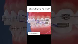 This is how braces work [upl. by Ijnek]