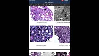 Kidney pathology part 3 [upl. by Clifford]