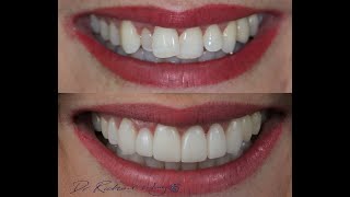 How to fix crooked teeth Smile Makeover Australia vol 13 with Dr Richard Crowns Veneers Hollywood [upl. by Atnom]