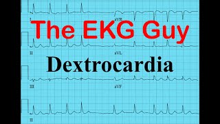 EKGECG  Dextrocardia  The EKG Guy  wwwEKGmd [upl. by Agnizn]