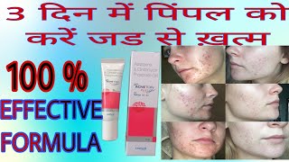 ACNETOIN GEL  चेहरे के दाग धब्बे पिंपल्स को कैसे रोकें  pimple Acnetoingel फुंसी मुंहासे [upl. by Desireah33]