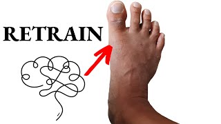 Get Rid Of Bunions For Good Nervous System Retraining [upl. by Asoramla]