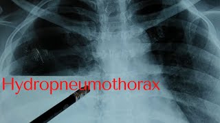 hydropneumothorax [upl. by Belinda]