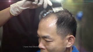 Hair Filler Treatment  Testimonial [upl. by Solrak]