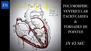 Polymorphic Ventricular Tachycardia Animation and ECG Shorts [upl. by Esinad]