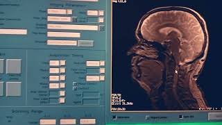 MRI venogram on GE 15T Hdxt sequence and post processing full detailed explanation [upl. by Destinee234]