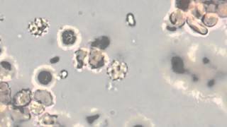 Spirochetes in Urine [upl. by Peppi]