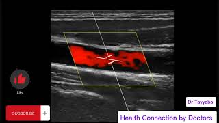 Introduction To Doppler Ultrasound  Health Connection by Doctors [upl. by Anasxor431]