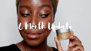 Dr V Facial Pigmentation Kit 6 Month Update  Lakisha Adams [upl. by Keever]