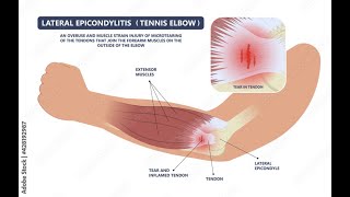 Tennis Ellenbogen  Arthroskopie Plica  DozDrPabinger [upl. by Enybor785]