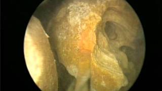 Laser Bladder Stone Lithotripsy mpg [upl. by Allain]