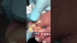 Ingrown toenail removal with Pedicure Knife Cut it easily Ep474 [upl. by Asaph]