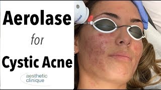 Aerolase for Cystic Acne [upl. by Bigelow282]