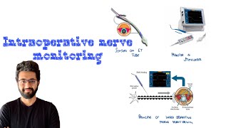 Intraoperative Neuromonitoring  IONM [upl. by Htebasil]